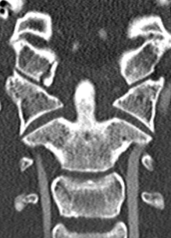 CTA coronar: Condylus occipitalis Fx Typ III n. Anderson und Montesano
