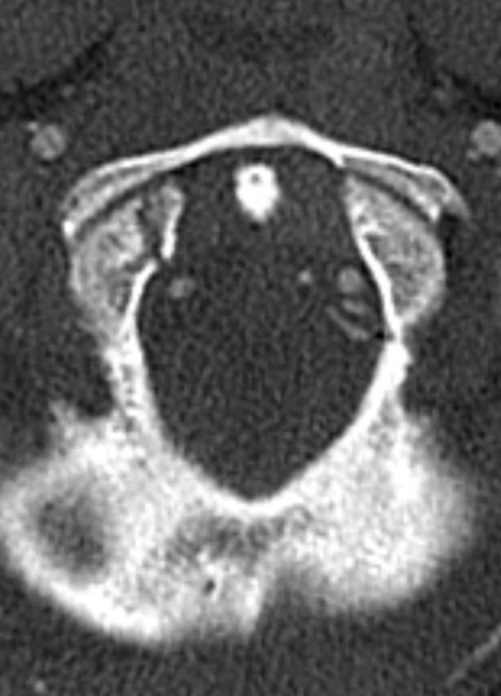 CTA axial: Condylus occipitalis Fx Typ III n. Anderson und Montesano