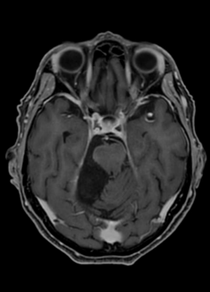 MRI T1+KM axial: Epidermoid des Kleinhirnbrückenwinkels bis präpontin