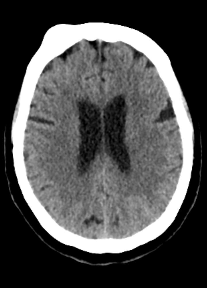 CT nativ axial: Frontal rechts gelegenes Hämangiom