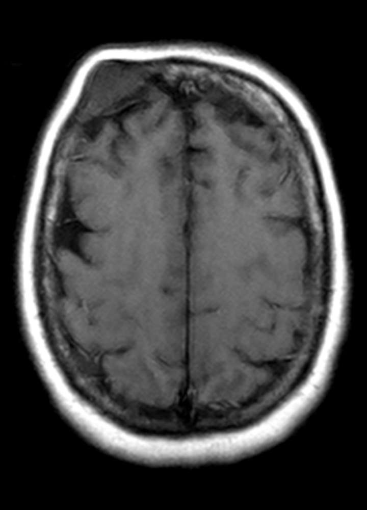 MRI T1 nativ axial: Hyper- isodenses Hämangiom