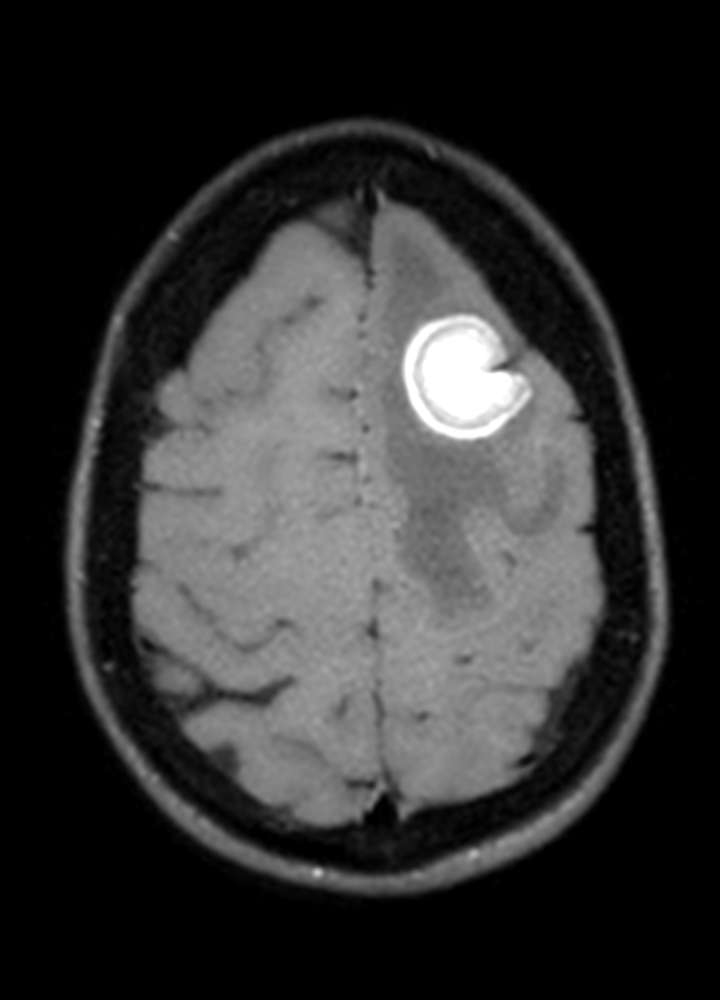MRI T1+KM axial: Hirnmetastase frontal links, solide, KM-enhancement
