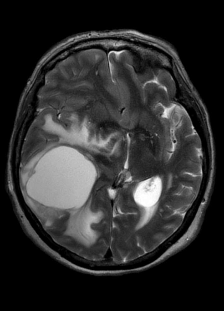 MRI T2 axial: Hirnmetastase temporooccipital, primär zystisch, verdängender Effekt mit Mittellinienverlagerung und peritumorales Hirnödem