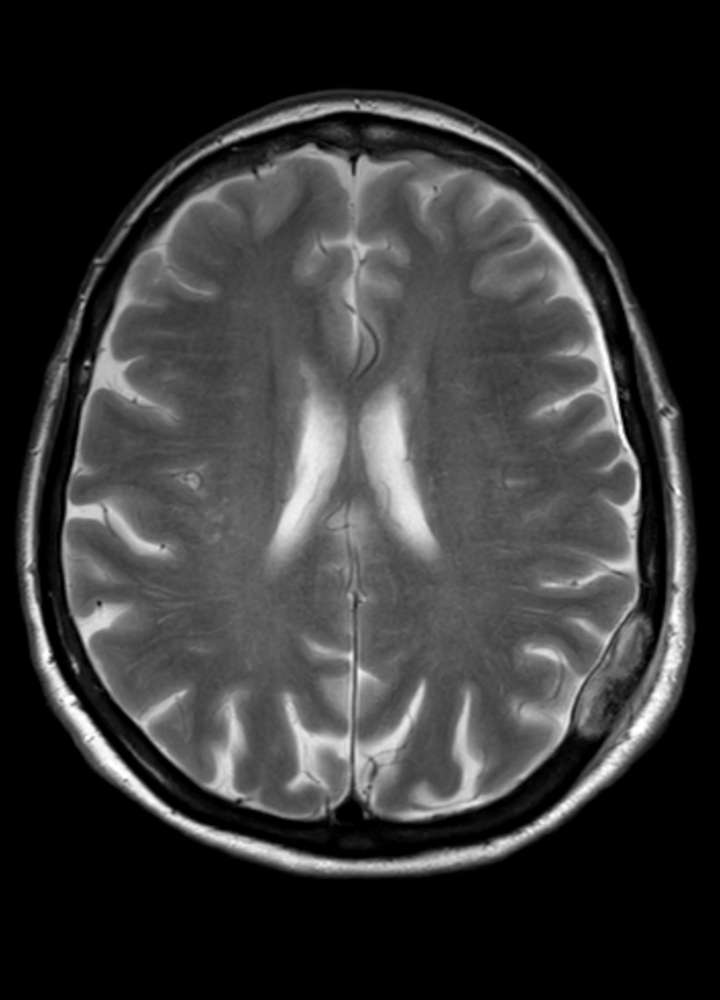 MRI T2 axial: Ossäre Metastase parietal