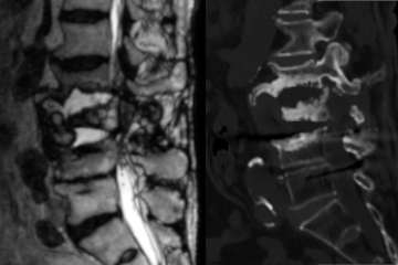 Spinale Charcot Arthropathie