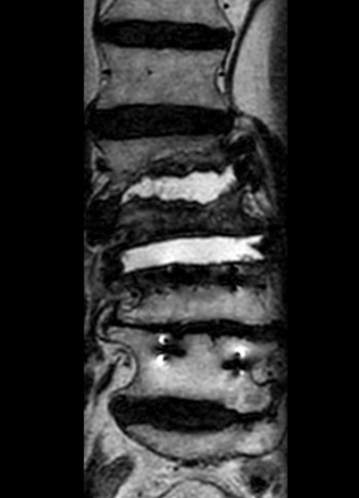 MRI coronar: Spinale Charcot Arthropathie mit Destruktion der Bandscheiben LWK 2/3 und 3/4, St. n. lumbaler Fusion