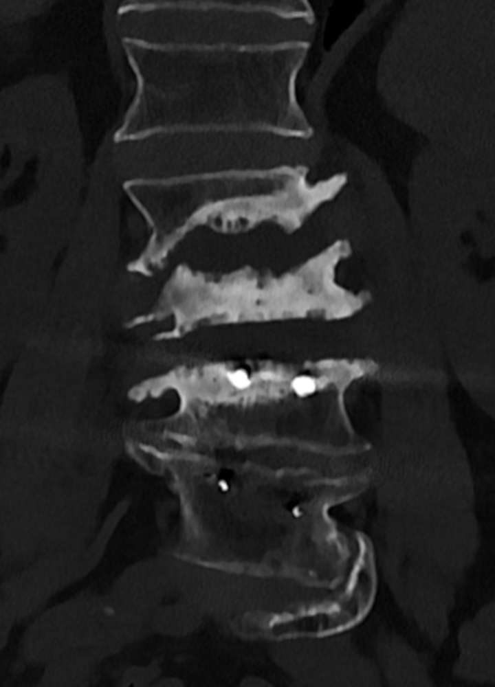 CT coronar: Spinale Charcot Arthropathie mit Destruktion der Bandscheiben LWK 2/3 und 3/4, Osteophyten Bildung, Sklerotische Veränderungen der Deck- und Bodenplatten, St. n. lumbaler Fusion