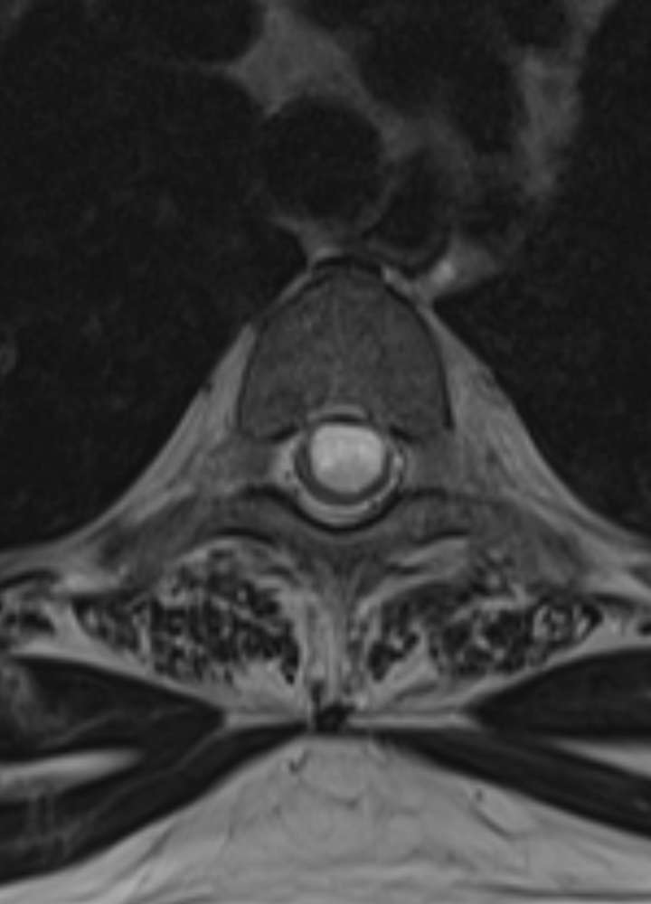 MRI T2 axiall: Neurenterische Zyste BWK 3 anterior des Myelons mit Kompressionseffekt