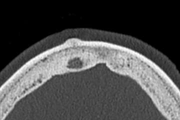 CT: Osteom frontal