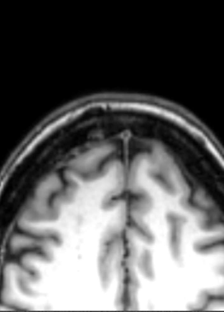 MRI T1: Osteom frontal