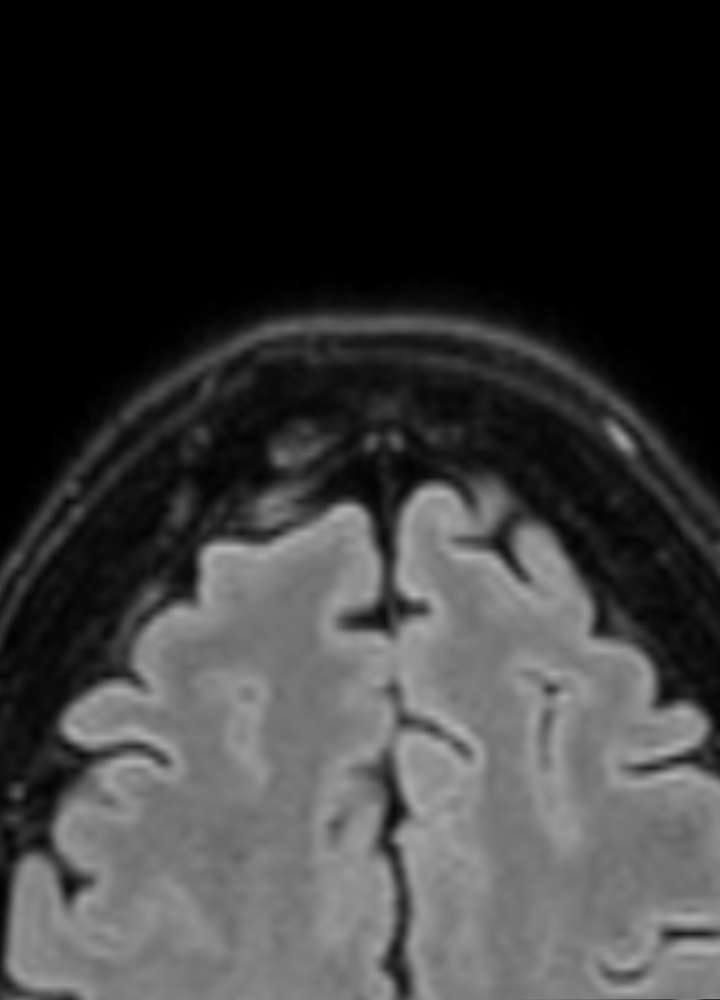 MRI FLAIR: Osteom frontal